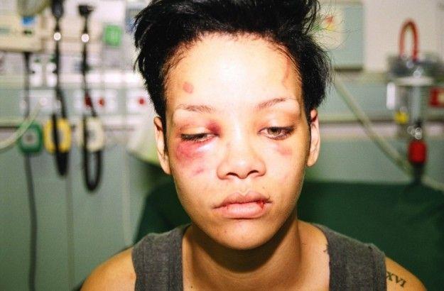 Rihanna picchiata da Chris Brown con volto tumefatto e labbro spaccato